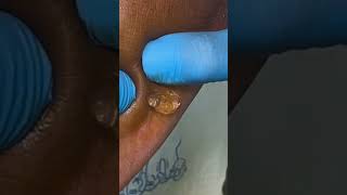 Ganglion cyst ganglioncysts ganglion feet footcare podiatry [upl. by Froma]