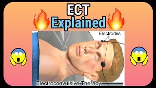 Electroconvulsive therapy ECT explained  How it is performed [upl. by Neeli]