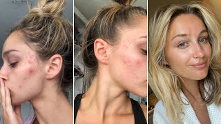 HOW I CLEARED MY ADULT ACNE [upl. by Schaffer]