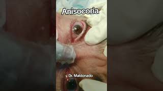 ANISOCORIA medicina seguridad ciencia sabiasque emergency curiosidades tratamientos [upl. by Brote396]