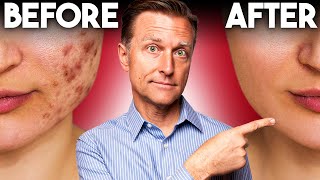 The FASTEST Way to Rid Acne  Dr Berg [upl. by Anelrahs551]