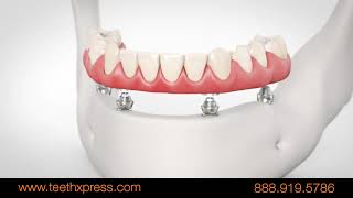 Replacing Missing Teeth with TeethXpress Dental Implants [upl. by Kal]