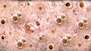 Amazing Blackheads Remover on the Face 003 [upl. by Hallam]