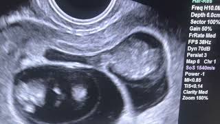 Ultrasound of Twin Pregnancy at 9 12 weeks [upl. by Nihhi]