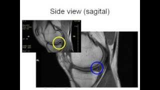 How to Read Knee MRI of Torn Meniscus  Meniscal Tear  Santa Fe Albuquerque Orthopedic Surgeon [upl. by Sebastian]