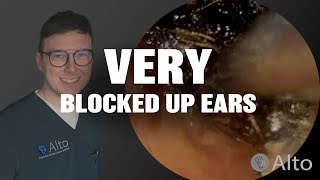 quotI literally cant hear a thingquot  Earwax Removal [upl. by Eta]