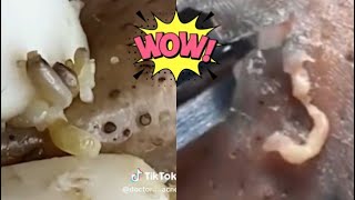 Ultimate Pimple Popping Compilation  Extreme Acne Treatment  Satisfying Blackhead Removal [upl. by Haeluj]