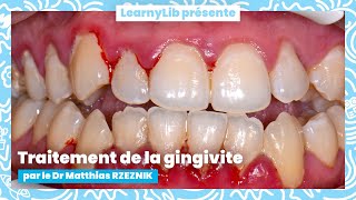 🦷 La parodontie  traitement de la gingivite avec le Dr Matthias RZEZNIK [upl. by Viglione172]