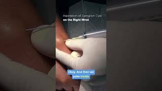 Aspiration of Ganglion Cyst hospital meded medical medicine doctor resident medicalstudent [upl. by Onirefez308]