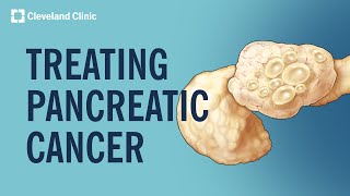 Treating Pancreatic Cancer [upl. by Kaliope]