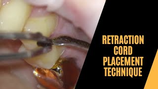 Retraction cord placement technique [upl. by Ecirp831]