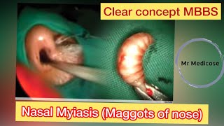 Nasal Myiasis Maggots of nose [upl. by Janus]