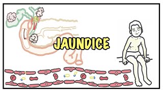 Approach to Jaundice  types and causes of hyperbilirubinemia investigations [upl. by Isador72]