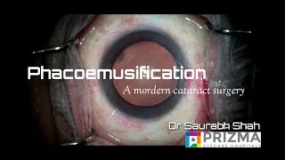 Phacoemulsification Procedure Explained  Ultramodern Cataract Surgery [upl. by Eloci]