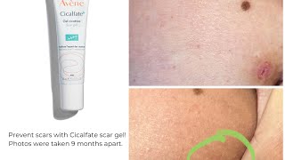 Avène Cicalfate Scar gel How to prevent scars treat them amp real before amp after photos included [upl. by Rysler]