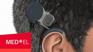 How Do Cochlear Implants Work The SYNCHRONY Cochlear Implant  MEDEL [upl. by Mata647]