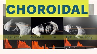 Choroidal Detachment  Haemorrhagic Vs Serous Atlas of B scan [upl. by Pathe]