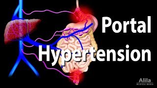 Portal Hypertension Animation [upl. by Yanffit]