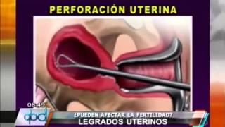 PROCREAR ¿Los legrados uterinos afectan la fertilidad [upl. by Nagiam586]