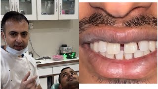 Mid line diastema  teeth gap closure दातों के बीच के गेप्स को भरना [upl. by Limemann]