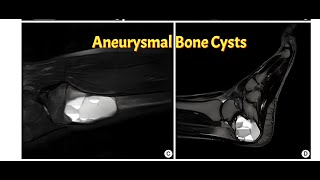 Aneurysmal Bone Cyst  The Bone Thats Alive [upl. by Fred]