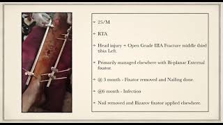 Revision Ilizarov fixation for Open grade IIIA fracture shaft tibia [upl. by Rihaz]