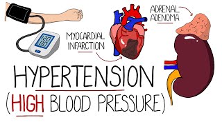 Hypertension Explained High Blood Pressure  Includes Hypertensive Emergency amp NICE Guidelines [upl. by Enneillij11]