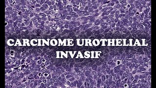 LE CARCINOME UROTHELIAL INVASIF SousTypes – PATHOLOGIE [upl. by Sevein112]