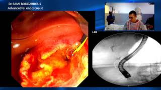 ERCP for biliary fistula [upl. by Nashom151]