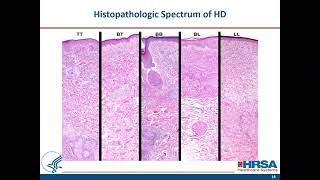 When to Suspect Leprosy Clinical Aspects and Treatment of Uncomplicated Hansens Disease [upl. by Crosby]