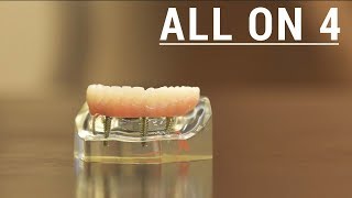 Top 3 questions people ask about AllOn4 Dental Implants [upl. by Ahseinod116]