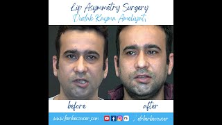 Lip Asymmetry Correction Surgery  Asymmetric Crying Facies Treatment [upl. by Asilem]