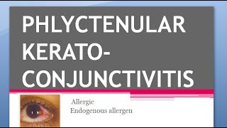 Ophthalmology PHLYCTENULAR KERATOCONJUNCTIVITIS KERATITIS TB Miliary Sacrofulous Fascicular Salzmann [upl. by Polly]