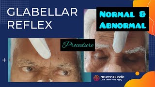 Glabellar Reflex  Myerson’s Sign reflexpathway cranialnerves positiveprimitivereflex neurology [upl. by Ettie736]