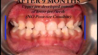 NonExtraction Orthodontic Braces Treatment  Crossbite Narrow JawExapander  Part 1 [upl. by Jackqueline]