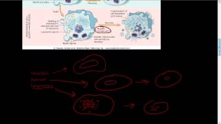 8  Micro and Macro morphology of necrosis  karyolysis pyknosis karyorrhexis necrosis [upl. by Emilie]