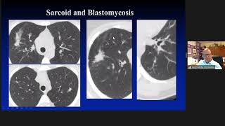 Oncological Imaging Practical Approach  Mimics of Malignancy Lung and pleura by Dr Luba Frank [upl. by Munn]