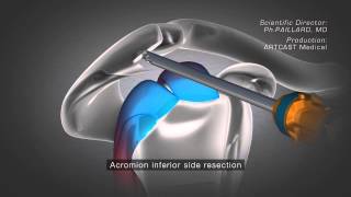 Shoulder Arthroscopy  Acromioplasty [upl. by Profant746]