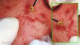 How To Removal Blackheads Big On The Face 194 [upl. by Dulla152]