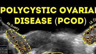 PCOD polycystic ovarian Disease [upl. by Alley458]