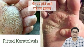 Pitted Keratolysis  Erythrasma  पैर पर होने वाले गड्ढे का इलाज़ fungalinfection fungalinfections [upl. by Gilbert]