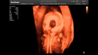 Embarazo de 23 semanas Menigoencefalocele occipital reconstrucción 3D del defecto óseo [upl. by Annaeel]