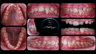 Class III with Traumatic occlusion  Full Case  DrAwfa [upl. by Rushing]