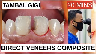 Step by Step Direct Veneers Composite Anterior Multiple Cases 20mins  General Dentist Griya RR [upl. by Greenland]