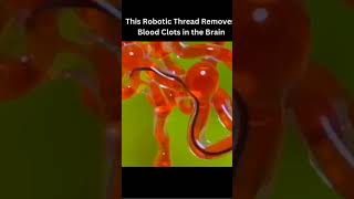 Robotic thread 🧵 removing blood clots 🩸 [upl. by Angi]