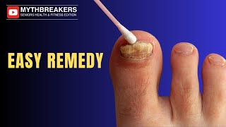 The Absolute Best Toenail Fungus Cure Revealed [upl. by Boaten267]