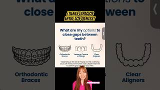 Tratamiento de los espacios entre los dientes shorts diastema diastemas espaciosentredientes [upl. by Anilos]