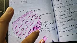 schwannoma histopathology gross and microscopic features [upl. by Altman535]