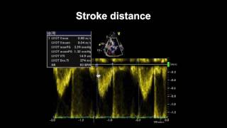 Echocardiography Essentials Assessing left ventricular global systolic function LVF [upl. by Assiralc]