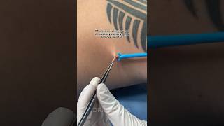 Skin Tag Removal in under 10 MINUTES  Dr Medispa [upl. by Ivek551]